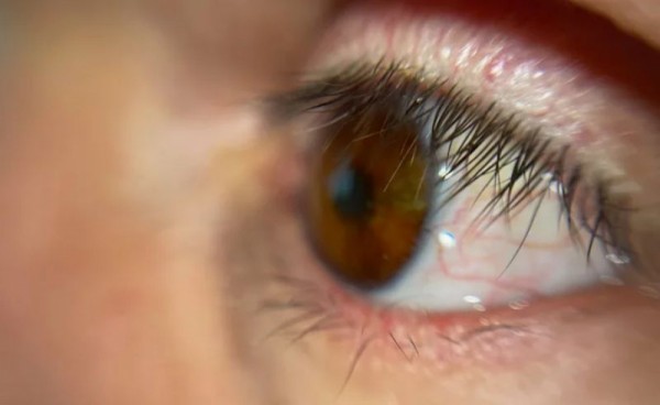 Bệnh nhân đầu tiên trên thế giới được lắp mắt giả bằng công nghệ in 3D