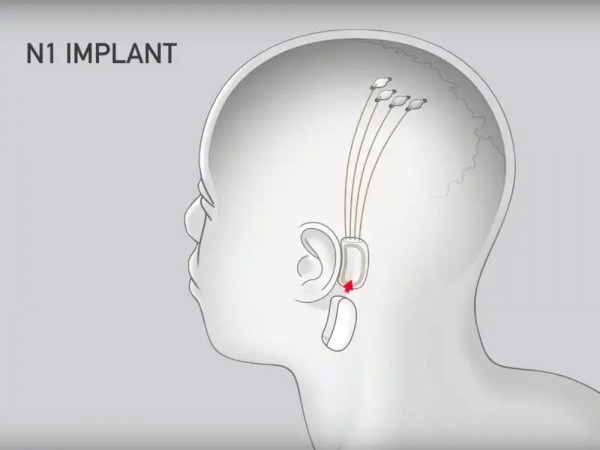 Neuralink lần đầu tiên cấy ghép chip vào não người