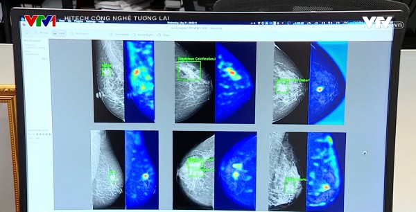 Ứng dụng AI giúp phát hiện ung thư vú qua sàng lọc nhũ ảnh