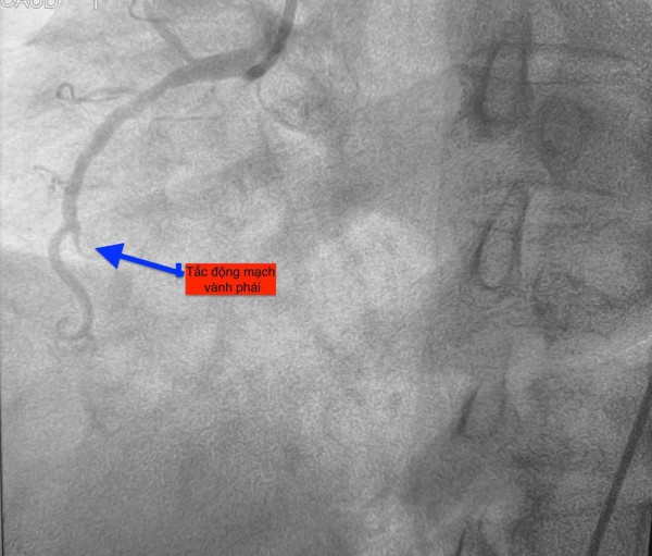 1 ngày 4 ca nhồi máu cơ tim cấp nhập viện, có bất thường? 1 ngày 4 ca nhồi máu cơ tim cấp nhập viện, có bất thường?