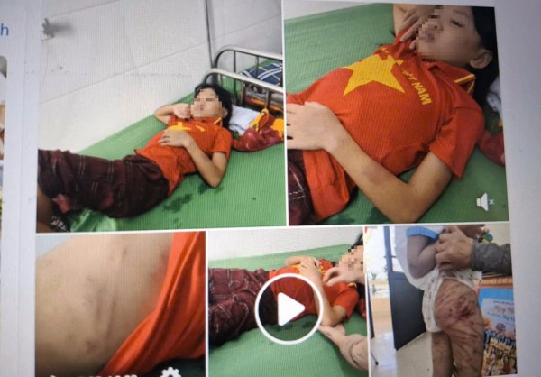 Bé gái 11 tuổi nhập viện, nghi bị cha dượng bạo hành Bé gái 11 tuổi nhập viện, nghi bị cha dượng bạo hành