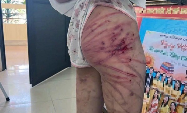 Bé gái 11 tuổi nhập viện, nghi bị cha dượng bạo hành Bé gái 11 tuổi nhập viện, nghi bị cha dượng bạo hành