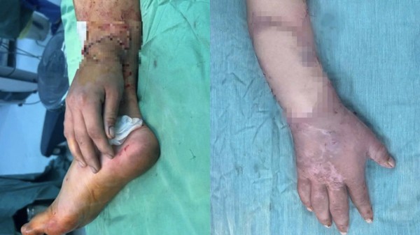 Bệnh viện đa khoa Bình Dương nối lại bàn tay đứt lìa cho thai phụ Bệnh viện đa khoa Bình Dương nối lại bàn tay đứt lìa cho thai phụ