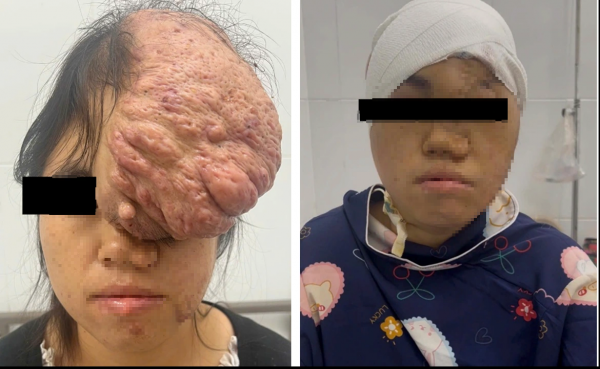 Cô gái Sơn La mang khối u sọ 15 năm được mổ thành công ở Bình Dương