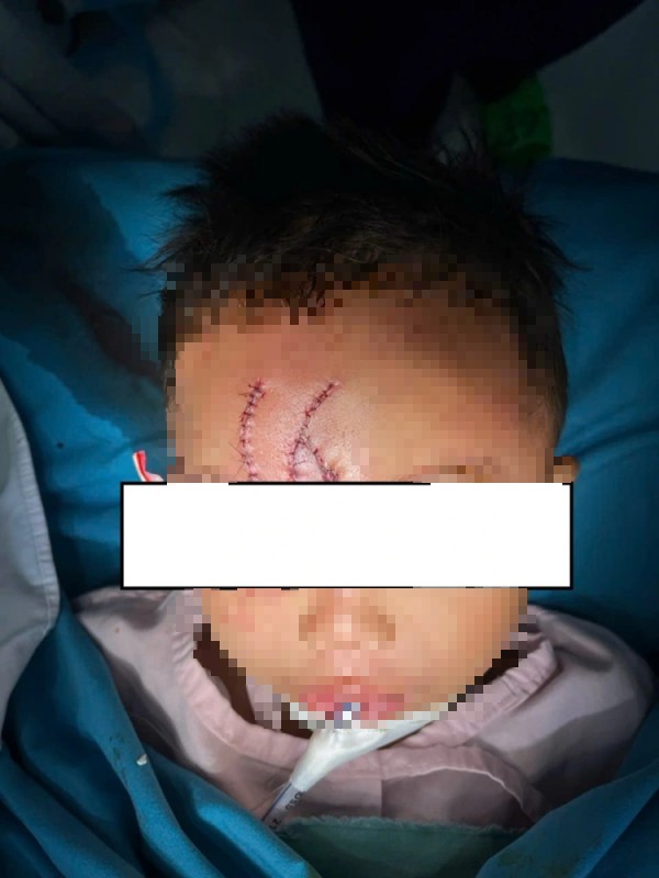 Cứu bé trai 5 tuổi bị chó béc giê cắn xé biến dạng khuôn mặt Cứu bé trai 5 tuổi bị chó béc giê cắn xé biến dạng khuôn mặt