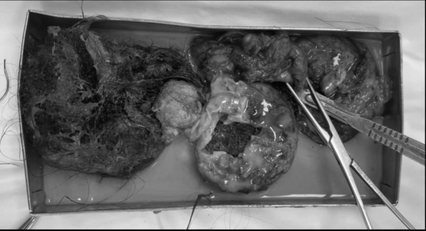 Cứu nữ bệnh nhân vỡ u quái buồng trứng, răng và tóc tràn ra ổ bụng Cứu nữ bệnh nhân vỡ u quái buồng trứng, răng và tóc tràn ra ổ bụng