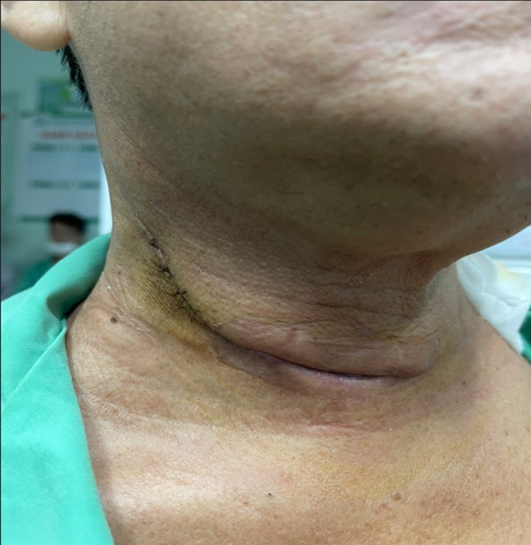 Khàn tiếng kéo dài, đi khám phát hiện mắc cùng lúc 2 loại ung thư Khàn tiếng kéo dài, đi khám phát hiện mắc cùng lúc 2 loại ung thư