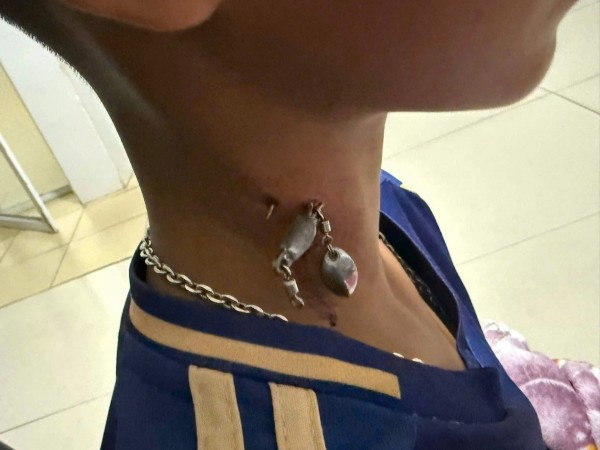 Móc câu mắc sâu vào cổ bệnh nhi 13 tuổi ở Quảng Trị