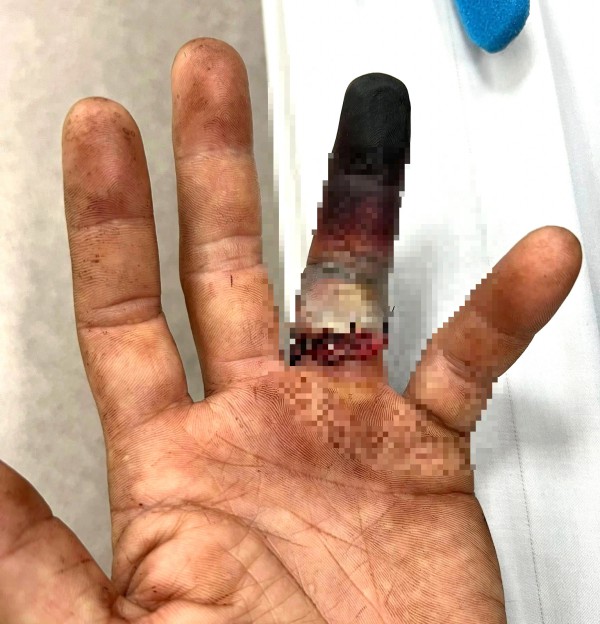 Nhẫn cưới mắc vào cửa xe, tài xế ở TP.HCM nguy cơ mất ngón tay Nhẫn cưới mắc vào cửa xe, tài xế ở TP.HCM nguy cơ mất ngón tay