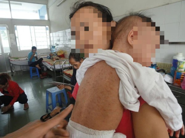 Phát hiện 2 trẻ ở TP.HCM mắc bệnh sởi vì chưa được tiêm vắc xin