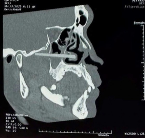 Say rượu ngã úp mặt, đôi đũa nhựa cắm mũi suốt một năm nhưng không biết Say rượu ngã úp mặt, đôi đũa nhựa cắm mũi suốt một năm nhưng không biết