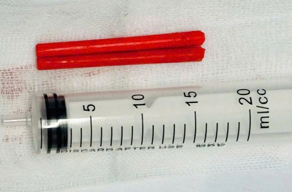 Say rượu ngã úp mặt, đôi đũa nhựa cắm mũi suốt một năm nhưng không biết Say rượu ngã úp mặt, đôi đũa nhựa cắm mũi suốt một năm nhưng không biết