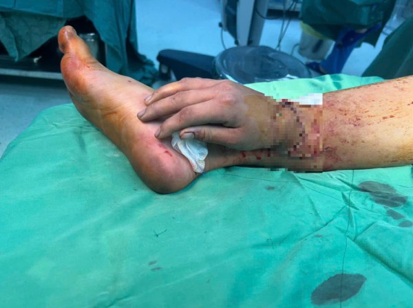 TP.HCM: Phẫu thuật thành công ca ghép bàn tay vào chân cho bệnh nhân mang song thai TP.HCM: Phẫu thuật thành công ca ghép bàn tay vào chân cho bệnh nhân mang song thai