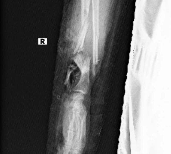 TP.HCM: Phẫu thuật thành công ca ghép bàn tay vào chân cho bệnh nhân mang song thai TP.HCM: Phẫu thuật thành công ca ghép bàn tay vào chân cho bệnh nhân mang song thai