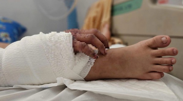 TP.HCM: Phẫu thuật thành công ca ghép bàn tay vào chân cho bệnh nhân mang song thai TP.HCM: Phẫu thuật thành công ca ghép bàn tay vào chân cho bệnh nhân mang song thai