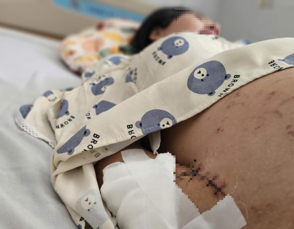 TP.HCM: Phẫu thuật thành công ca ghép bàn tay vào chân cho bệnh nhân mang song thai TP.HCM: Phẫu thuật thành công ca ghép bàn tay vào chân cho bệnh nhân mang song thai