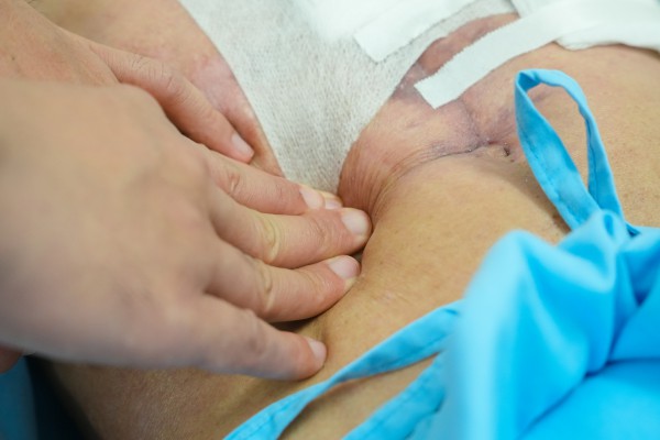 Đau bụng nhưng tự uống thuốc, người đàn ông bị thủng dạ dày, ngưng tim trên bàn mổ