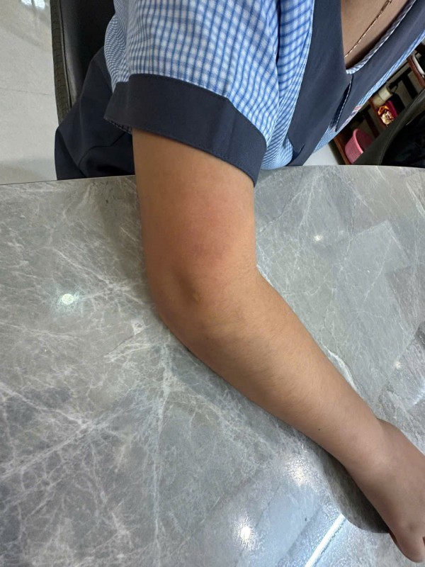 Vụ cô giáo dùng thước đánh học sinh 'chấn thương' tay: Phường công bố thông tin mới