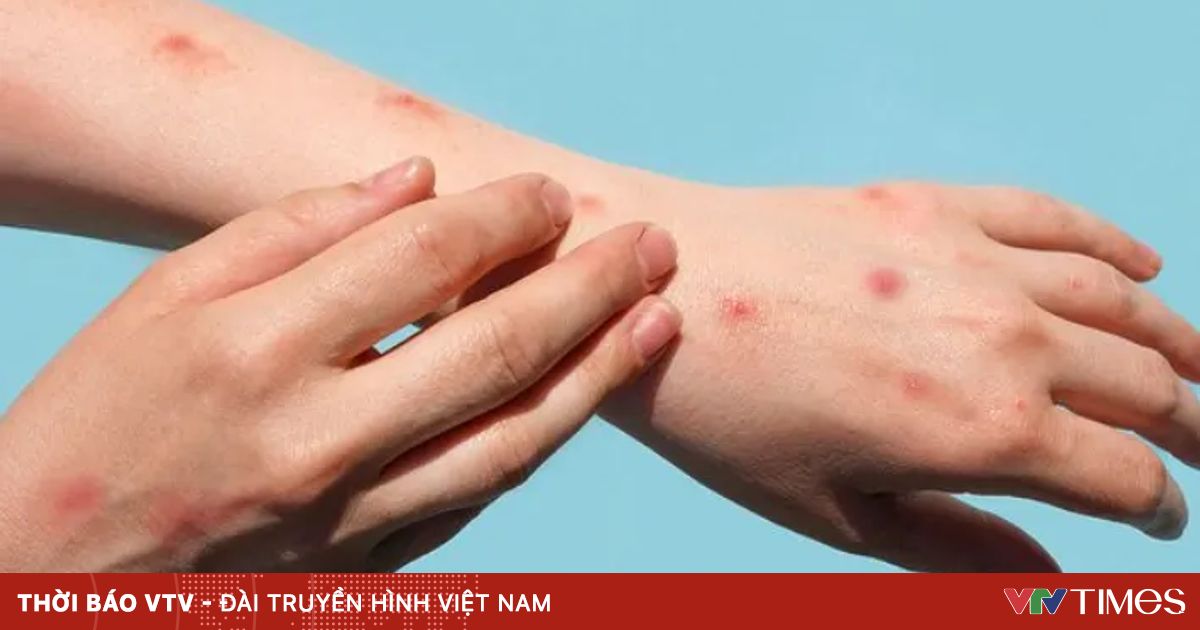 Bộ Y tế yêu cầu tăng giám sát, phát hiện ca nghi ngờ đậu mùa khỉ ngay tại cửa khẩu