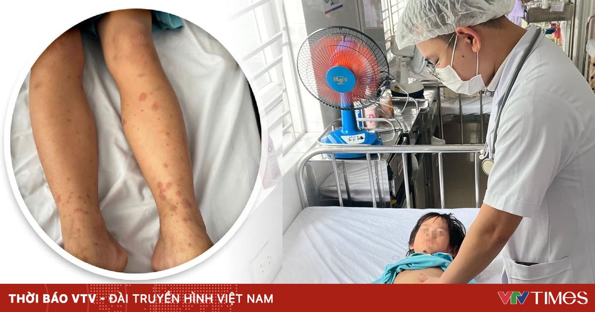 Cẩn trọng viêm mao mạch dị ứng ở trẻ