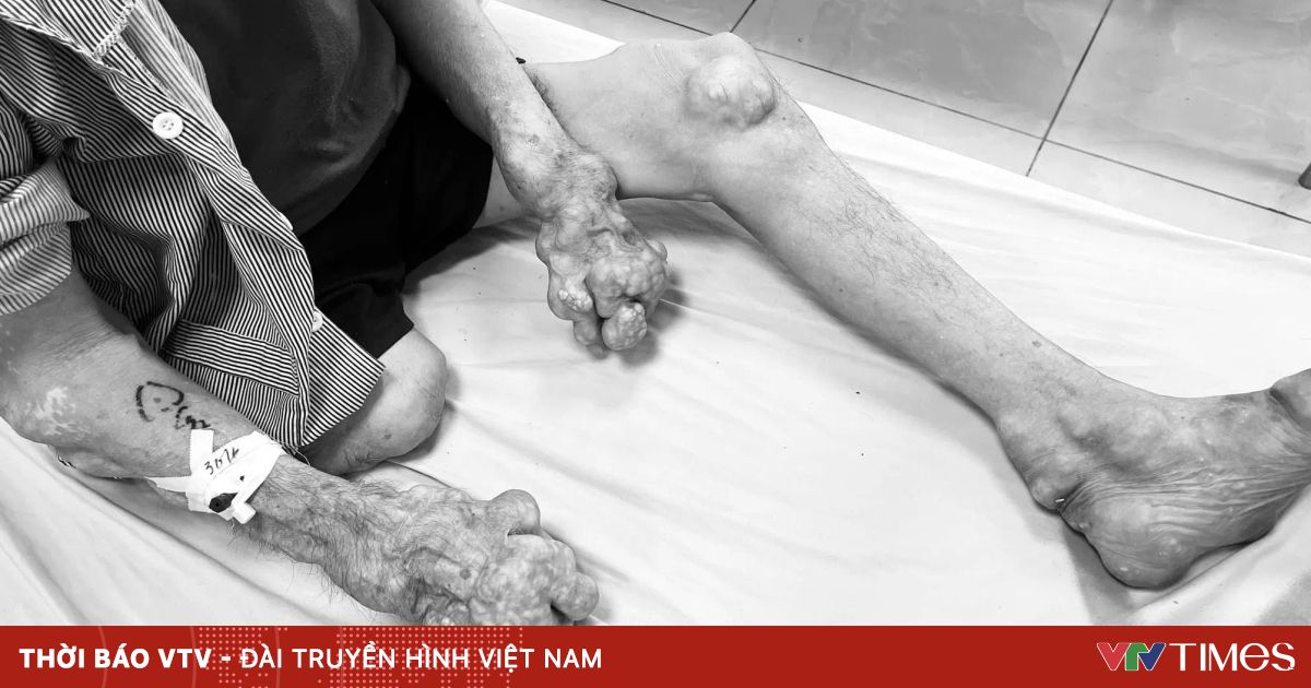 Cảnh báo biến chứng nhiễm trùng hạt tophi do bệnh gout lâu năm