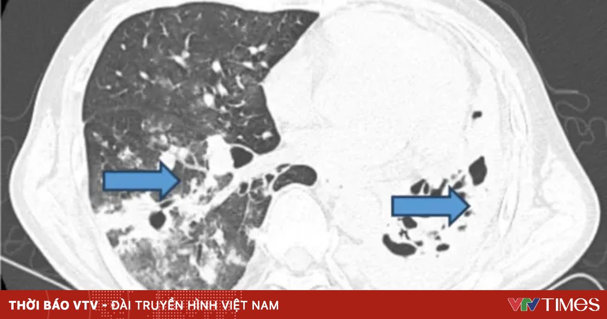 Cứu sống bệnh nhân ho ra máu nặng do lao phổi đa kháng thuốc