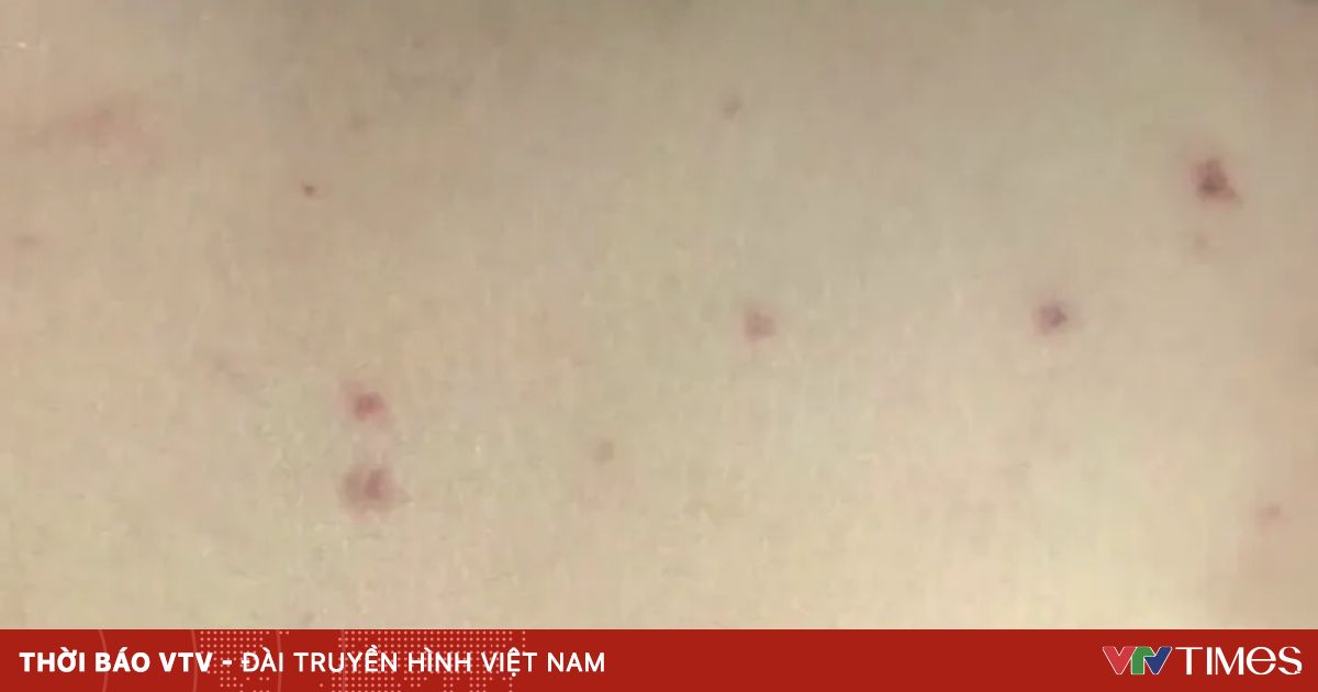 Hà Nội ghi nhận 1 ca mắc não mô cầu tại quận Hoàn Kiếm