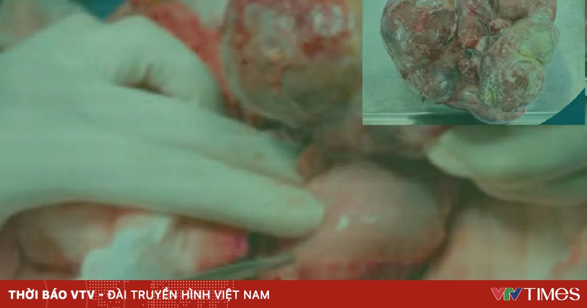 Lấy khối u quái nặng gần 1kg trong dạ dày bé sơ sinh