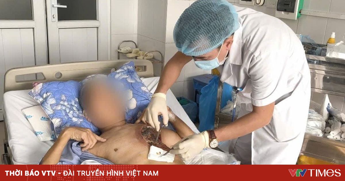 Mắc nấm hiếm gặp, người đàn ông hoại tử mô cơ vùng ngực trái