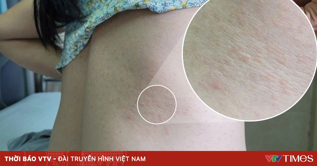 Mẩn ngứa tái đi tái lại, người phụ nữ phát hiện nhiễm giun đũa chó, mèo