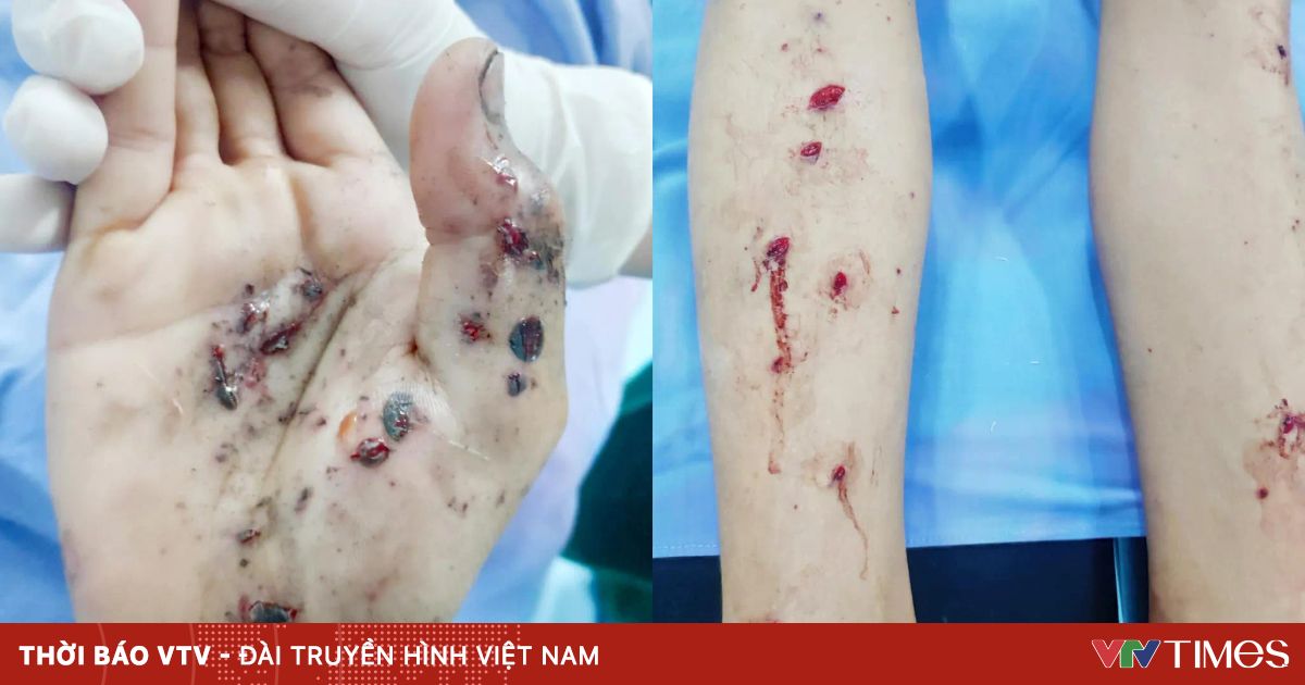 Mỗi năm Việt Nam có hơn 1,1 triệu trường hợp bị tai nạn thương tích