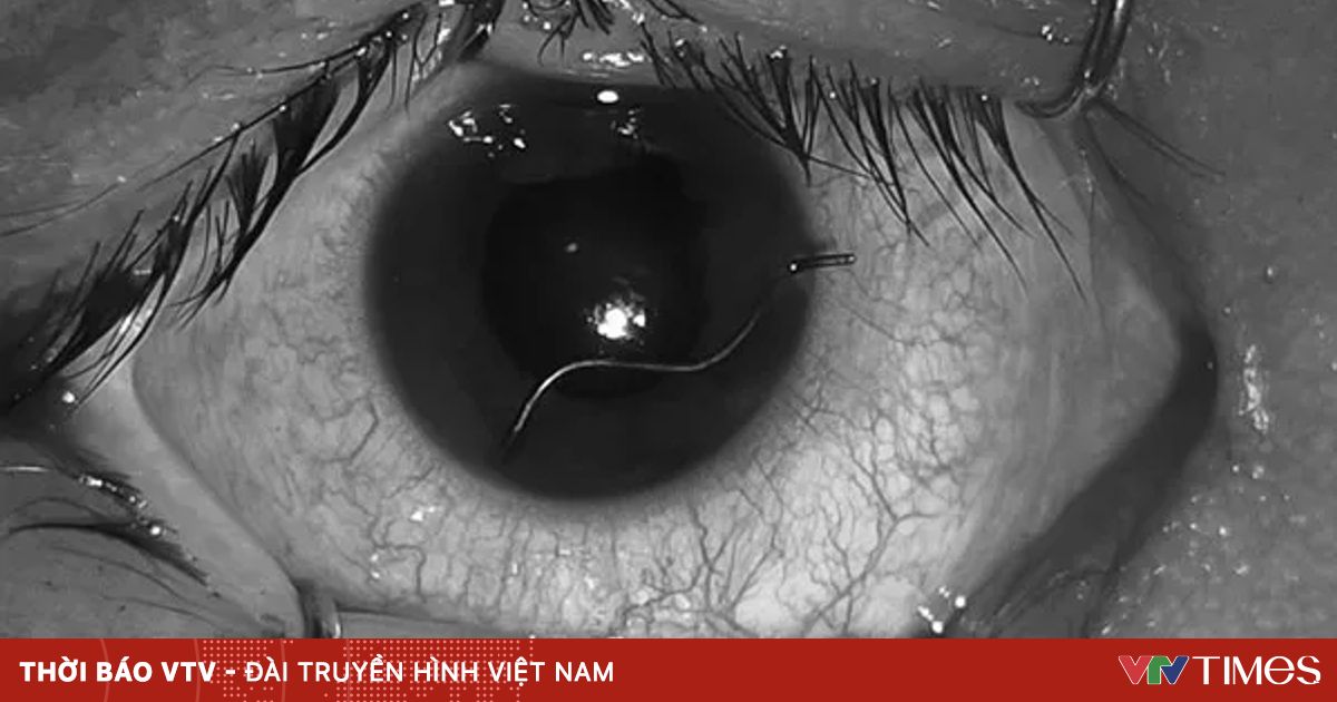 Nam thanh niên nhập viện với đoạn dây thép xuyên nhãn cầu