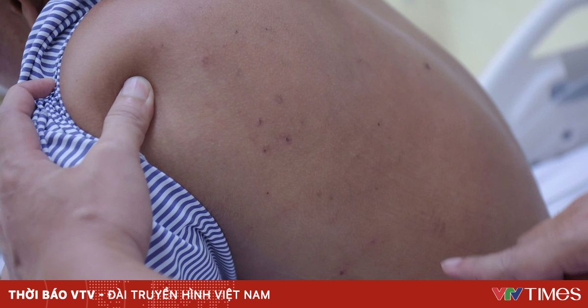 Người đàn ông nguy kịch vì ong vò vẽ đốt hơn 50 vết