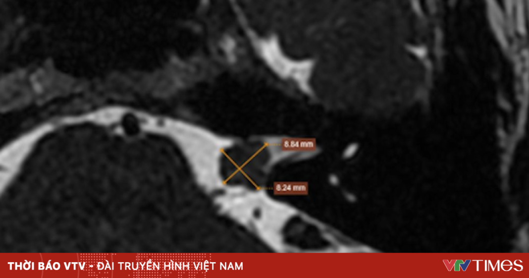 Người phụ nữ nguy cơ mất thính lực do khối u tại dây thần kinh số 8