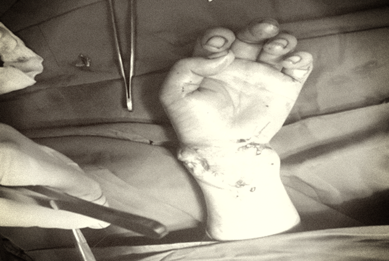 Nối thành công bàn tay trái bị đứt lìa cho bệnh nhân