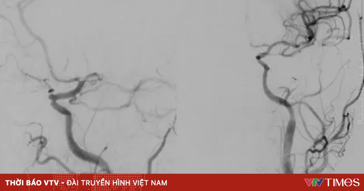 Tỉnh dậy lúc sáng sớm, người đàn ông không thể nói chuyện, yếu liệt nửa người