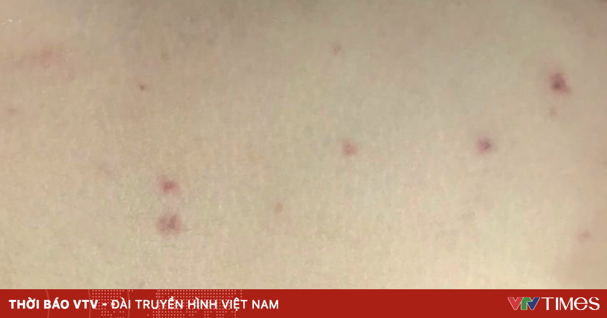 Trẻ mắc não mô cầu nặng do chưa tiêm vaccine phòng bệnh