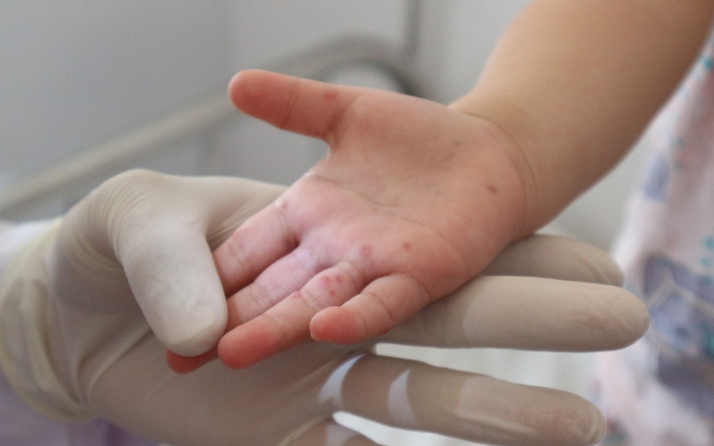 Đắk Lắk: Một bệnh nhi tử vong vì tay chân miệng