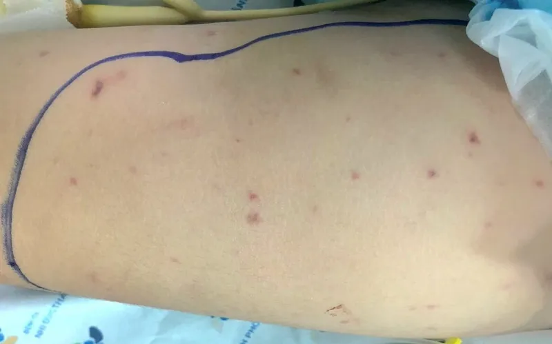 Đồng Nai ghi nhận trường hợp mắc não mô cầu, chưa tiêm vaccine phòng bệnh