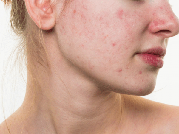 Chăm da theo trào lưu trên mạng xã hội là gây hại cho da