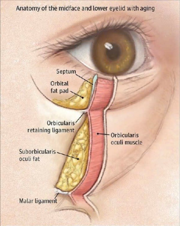 Hết mỡ bọng mắt mà không cần phẫu thuật
