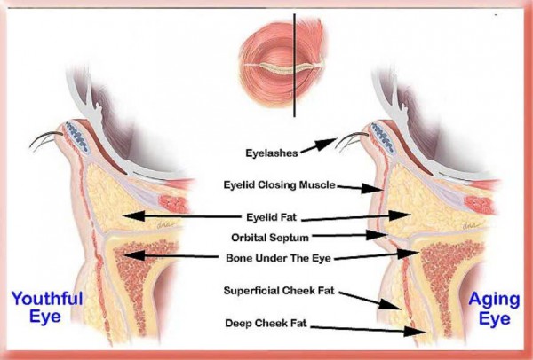 Hết mỡ bọng mắt mà không cần phẫu thuật
