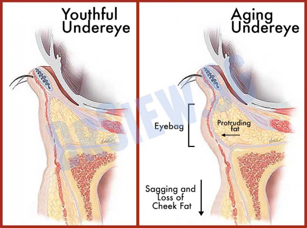 Hết mỡ bọng mắt mà không cần phẫu thuật