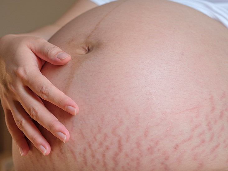 Mách bạn bí quyết hạn chế rạn da khi đang mang thai hiệu quả