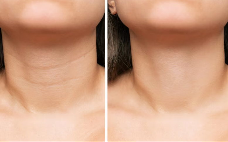 Những lý do nên dưỡng da cổ ngay từ “tuổi 20” Những lý do nên dưỡng da cổ ngay từ “tuổi 20”