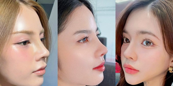 Tháo sụn mũi: Khi nào cần 