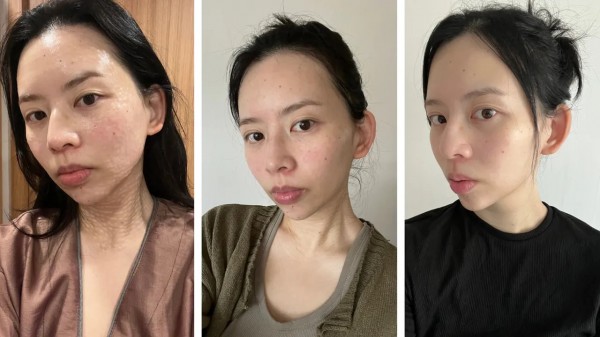 Tiêm tinh chất cá hồi: Cảnh giác với bẫy thẩm mỹ trong các 