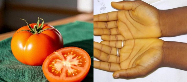 Ăn nhiều cà rốt, cà chua có thể khiến da đổi màu