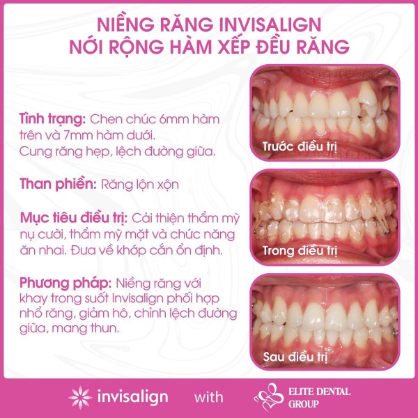 Niềng răng trong suốt có đau không, giai đoạn nào đau nhất?