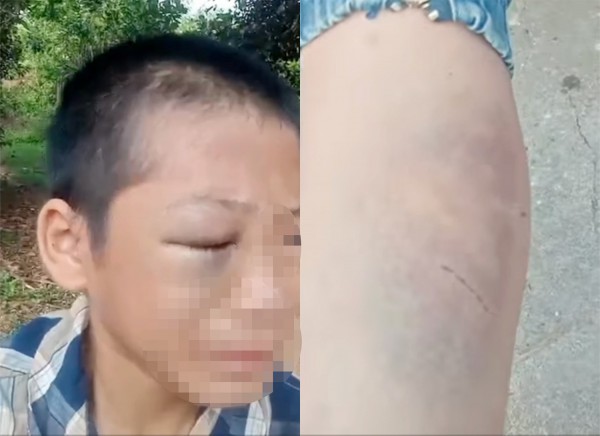 Bé trai nghi bị mẹ kế và bố đẻ đánh phải nhập viện điều trị Bé trai nghi bị mẹ kế và bố đẻ đánh phải nhập viện điều trị